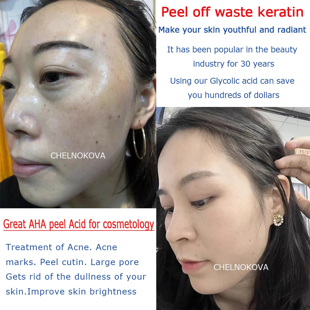 Citric acid 20% 30% 40% 50% peel Material of Skincare 5ml 10ml Brighten skin whiten keratin aha whitening body lotion peeling