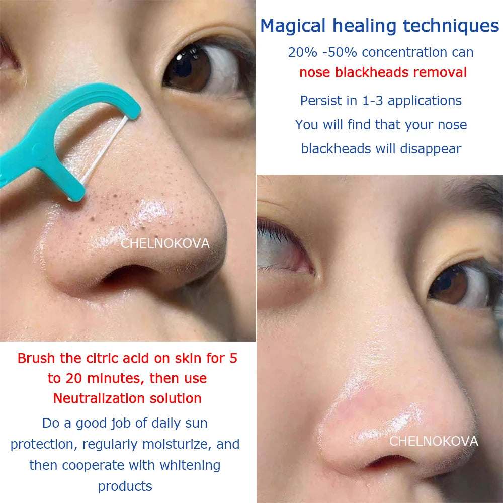 Citric acid 20% 30% 40% 50% peel Material of Skincare 5ml 10ml Brighten skin whiten keratin aha whitening body lotion peeling