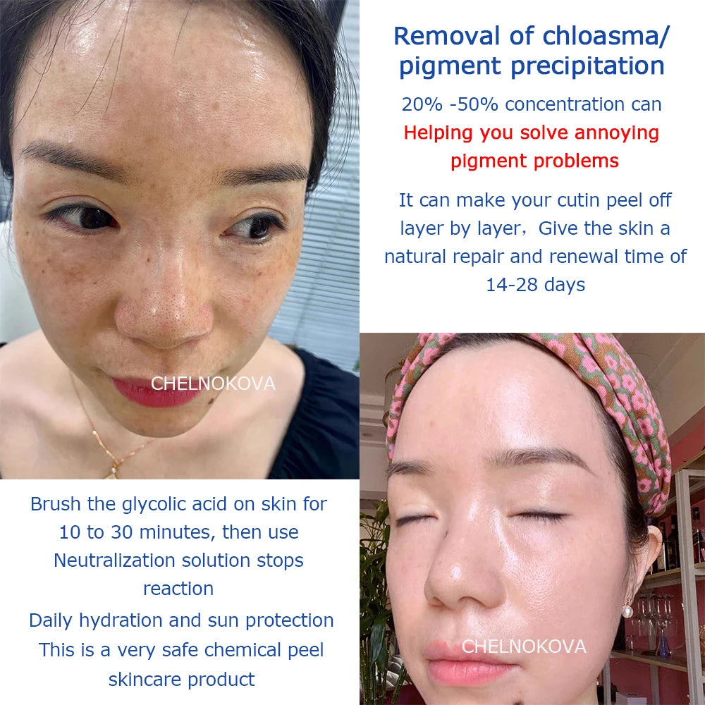 Citric acid 20% 30% 40% 50% peel Material of Skincare 5ml 10ml Brighten skin whiten keratin aha whitening body lotion peeling